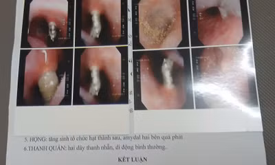 Bệnh nhân N.C.K bị 4 chiếc đinh vít nong hàm chọc thẳng lên mũi. Ảnh: NVCC.
