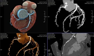 Bệnh nhân thoát nguy cơ ‘thượng mã phong’ nhờ chia sẻ chuyện phòng the