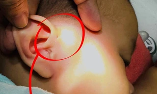 Bé gái bị áp xe thái dương, bác sĩ cảnh báo dị tật dễ bị bỏ qua