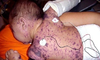 Bác sĩ cảnh báo sau ca tử vong do não mô cầu