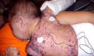 Bác sĩ cảnh báo sau ca tử vong do não mô cầu