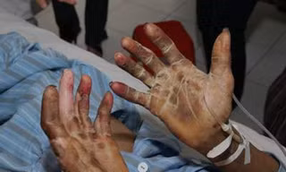 Xẻ thịt lợn không đồ bảo hộ, người đàn ông đối mặt nguy cơ mất thính lực suốt đời