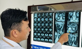 Người đàn ông bị 'sát thủ' sỏi san hô khổng lồ phá hủy thận 