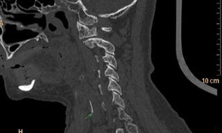Những 'mẹo' chữa hóc xương phản khoa học, có thể gây chết người 