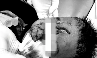 Bé trai 5 tuổi bị chó béc giê nhà hàng xóm cắn nát mặt