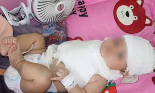 Bé trai 'khổng lồ' bị liệt cánh tay do sang chấn sản khoa khi chào đời