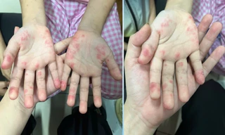 Bệnh nhi hai lần bị chẩn đoán nhầm vì căn bệnh tự miễn ‘giấu mặt’