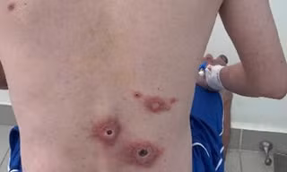 Nam nhân viên văn phòng lở loét toàn thân vì quan hệ tình dục bừa bãi