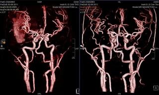 Cứu sống nam sinh hôn mê sâu do vỡ mạch máu não