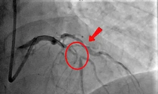 May mắn thoát chết khi bị nhồi máu cơ tim cấp tại bệnh viện