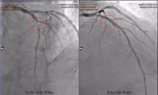 Cứu bệnh nhân quốc tịch Pháp khỏi nguy cơ đột tử ở phút 89