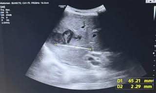 Nguy kịch tính mạng vì thói quen phổ biến sau bữa ăn của người Việt