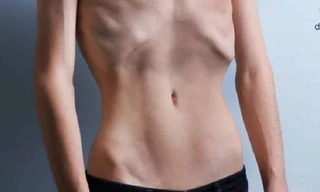 Nam thanh niên mê tập gym nhưng gầy trơ xương vì bệnh hiếm gặp