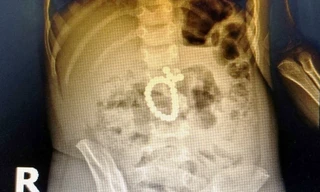 Bé trai thủng ruột 8 lỗ vì món đồ chơi nhiều trẻ thích mê mẩn