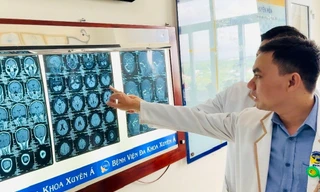 Đau đầu dai dẳng coi chừng 'sát thủ' trong não