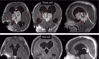 Bé sơ sinh bị u não, bác sĩ cảnh báo dấu hiệu cần nhập viện ngay