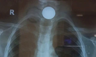 Hành trình 'chạy viện' căng thẳng của bé trai bị đồng xu kẹt ngang họng