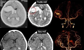 Hy hữu bé gái 13 tuổi bị đột quỵ 