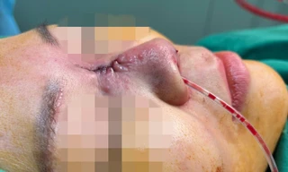 Trả giá đắt vì nghe lời thầy phong thủy nâng mũi đổi vận 