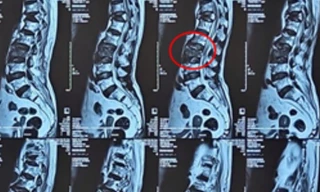 Bơm ‘xi măng’ vào đốt sống cứu cụ bà 100 tuổi