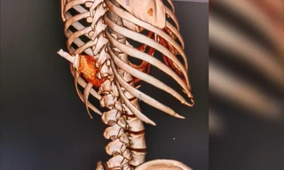 Người phụ nữ nhập viện với con dao Thái Lan cắm trên lưng