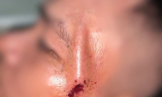 Người đàn ông nhập viện với khúc cây xuyên vào thái dương