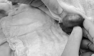 Nửa đêm đau âm ỉ vùng kín, nam sinh suýt mất tinh hoàn vì chủ quan