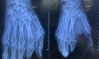 Xuyên đêm phẫu thuật cứu 4 ngón tay bị máy chém đứt lìa ở TPHCM