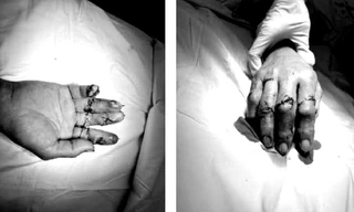 Xuyên đêm phẫu thuật cứu 4 ngón tay bị máy chém đứt lìa ở TPHCM