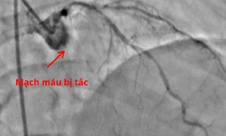 Chết lâm sàng vì bỏ qua dấu hiệu cảnh báo nhồi máu cơ tim cấp