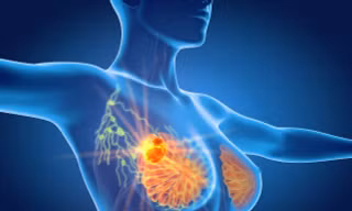 Phát hiện đột biến gen di truyền trên bệnh nhân ung thư vú