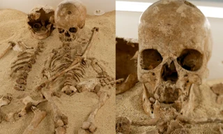 Bệnh lùn hiếm gặp bất ngờ được phát hiện từ hài cốt cách đây 12.000 năm tại Ý