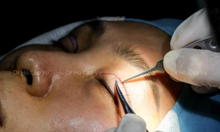 Thẩm mỹ 'chui' dùng người không bằng cấp tiêm filler, cắt mí trái phép cho khách