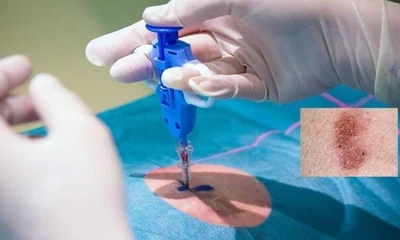 Ung thư da: Nguy hiểm tiềm ẩn từ những tổn thương không đau, không ngứa