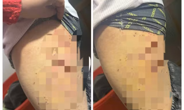 Nữ sinh lớp 7 bị bạn dùng bút bi đâm chi chít vào đùi