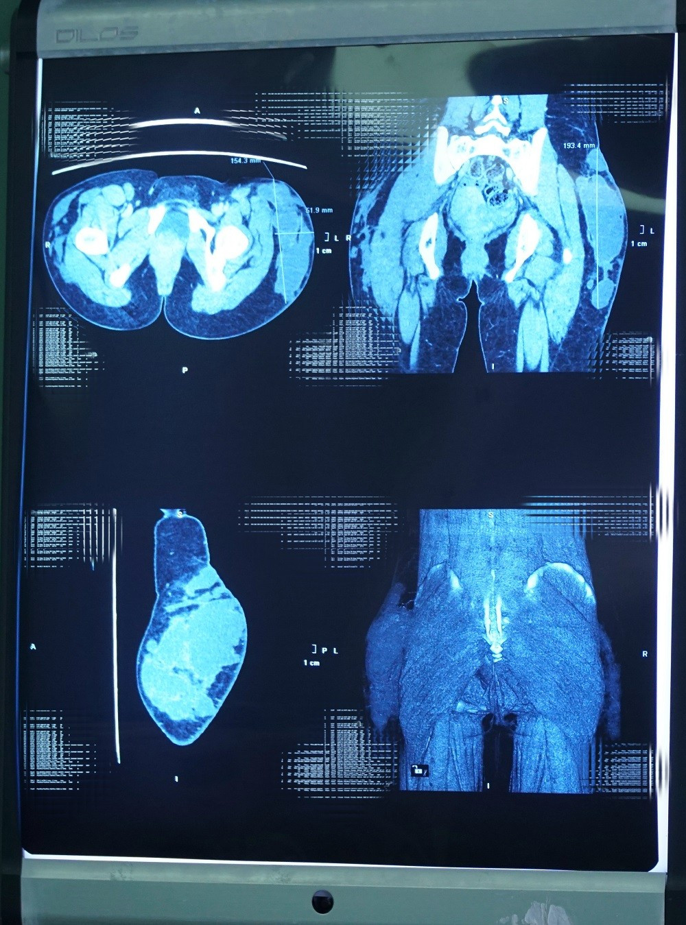 Hình ảnh kiểm tra ghi nhận các ổ nhiễm trùng hoại tử khiến mô cơ của người bệnh nham nhở như tổ ong hinh-anh-mri-khoi-ap-xe-mong.jpg
