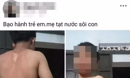 Công an vào cuộc vụ bé trai ở Đắk Lắk nghi bị mẹ tạt nước sôi