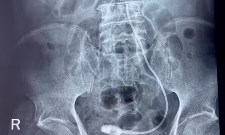 Để quên ống nhựa trong đường tiết niệu của cụ ông 9 năm