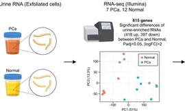 Nước tiểu có thể xác định chính xác ung thư tuyến tiền liệt