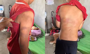 Công an vào cuộc xác minh vụ cháu bé đầy vết bầm tím trên cơ thể