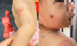 Phụ huynh bức xúc khi con gái hơn 2 tuổi chi chít vết cắn trên người sau giờ học 