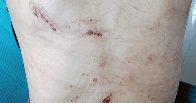 Các vết thương trên người chị B.T.T.G. Các vết thương trên người chị B.T.T.G.