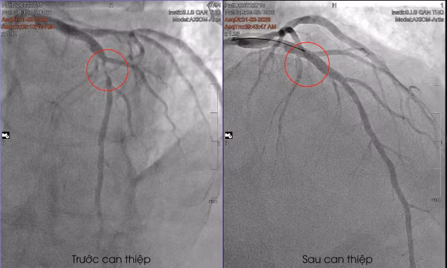Cứu bệnh nhân quốc tịch Pháp khỏi nguy cơ đột tử ở phút 89
