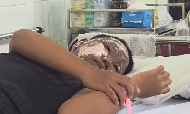 Chơi pháo nổ, bé trai bị tai nạn cháy đen khuôn mặt