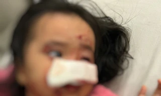 Dạo chơi cùng bố, bé gái 4 tuổi bị chó cắn nát mặt thương tâm