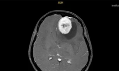 Người phụ nữ bị u màng não khổng lồ, bác sĩ chỉ ra những dấu hiệu dễ nhầm lẫn