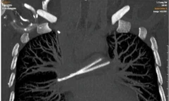 Ống truyền hóa chất trôi vào tim, bị 'bỏ quên' nhiều năm trong cơ thể