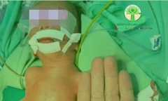 ‘Nhường’ máu nuôi người anh song thai, bé trai sinh non nguy kịch