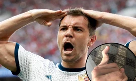 Đấu Croatia, ngôi sao tuyển Nga khoe chấn thương 'kỳ dị'