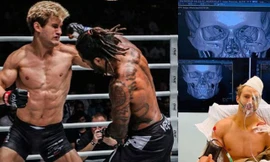 Sage Northcutt phải nhập viện vì bị đối thủ đấm rạn xương mặt.